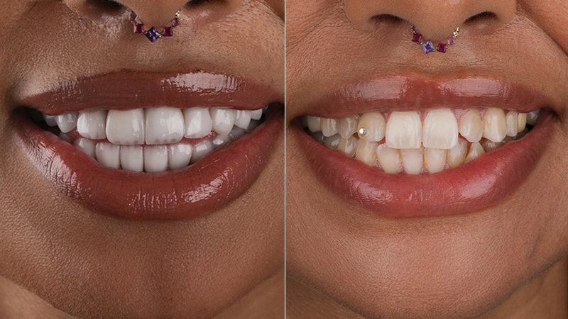 تجميل ابتسامة إيمان